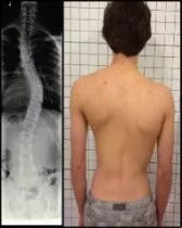 脊柱侧弯患者的日常矫正