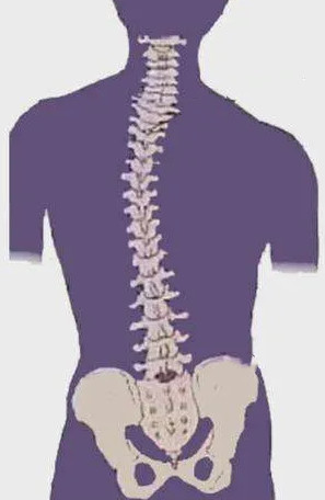 脊柱侧弯的最佳治疗期与预防