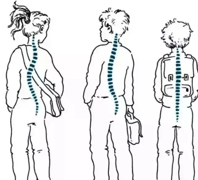 脊柱侧弯患者日常注意