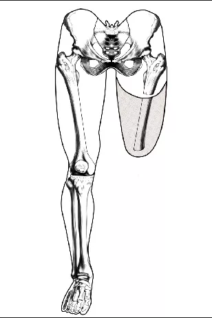 大腿假肢的各种组合