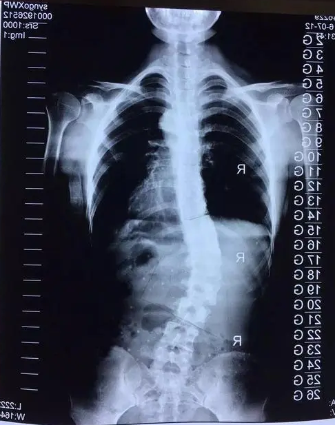 拍摄X光片的正确姿势（脊柱侧弯）