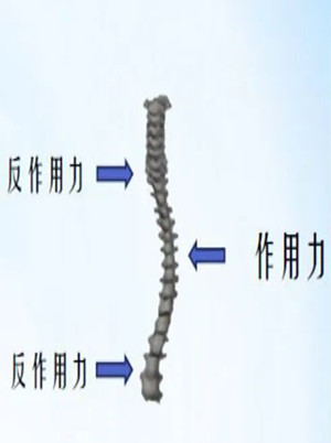 什么是脊柱侧弯矫形器？