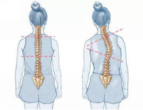 脊柱侧弯的日常预防