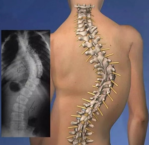 脊柱侧弯患者的日常注意事项
