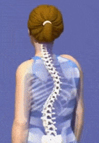 不适合脊柱侧弯患者的运动
