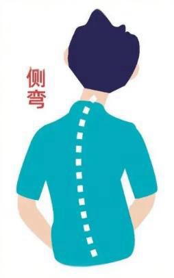 脊柱侧弯与家庭自查