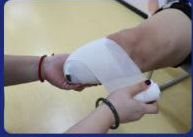 截肢术后的残肢塑型