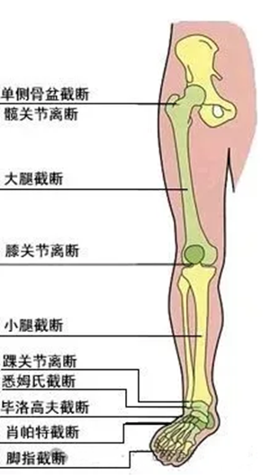 下肢截肢类型