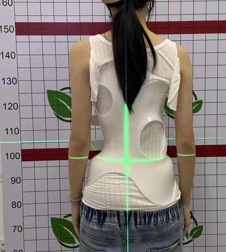 脊柱侧弯穿戴