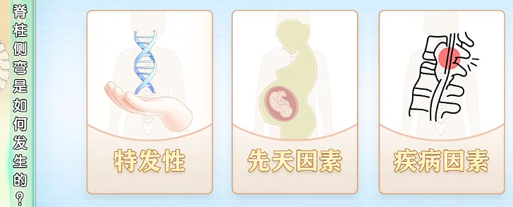 脊柱侧弯是如何发生的