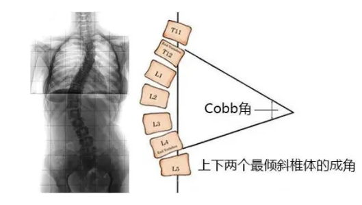 脊柱侧弯角度怎么测量？