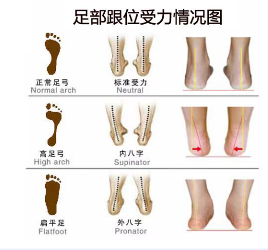 扁平足和脊柱侧弯之间有关联吗？