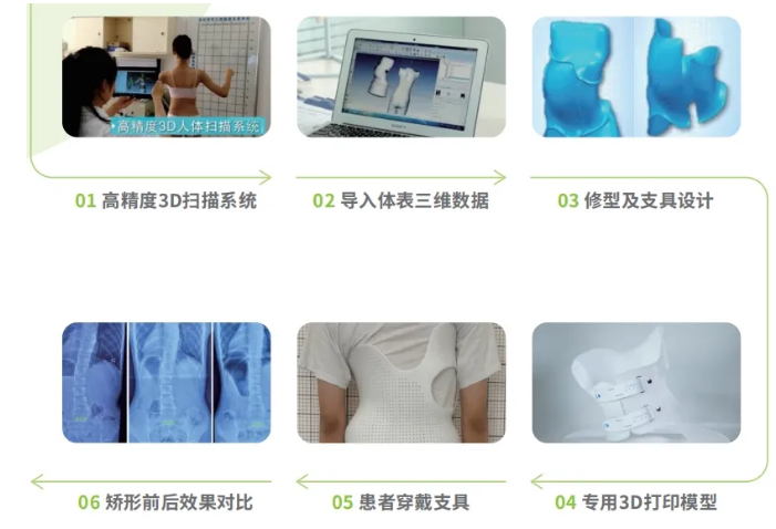 传统脊柱侧弯支具与3D打印矫形支具的区别  