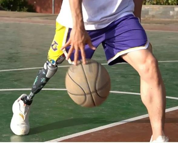 现代假肢的安装