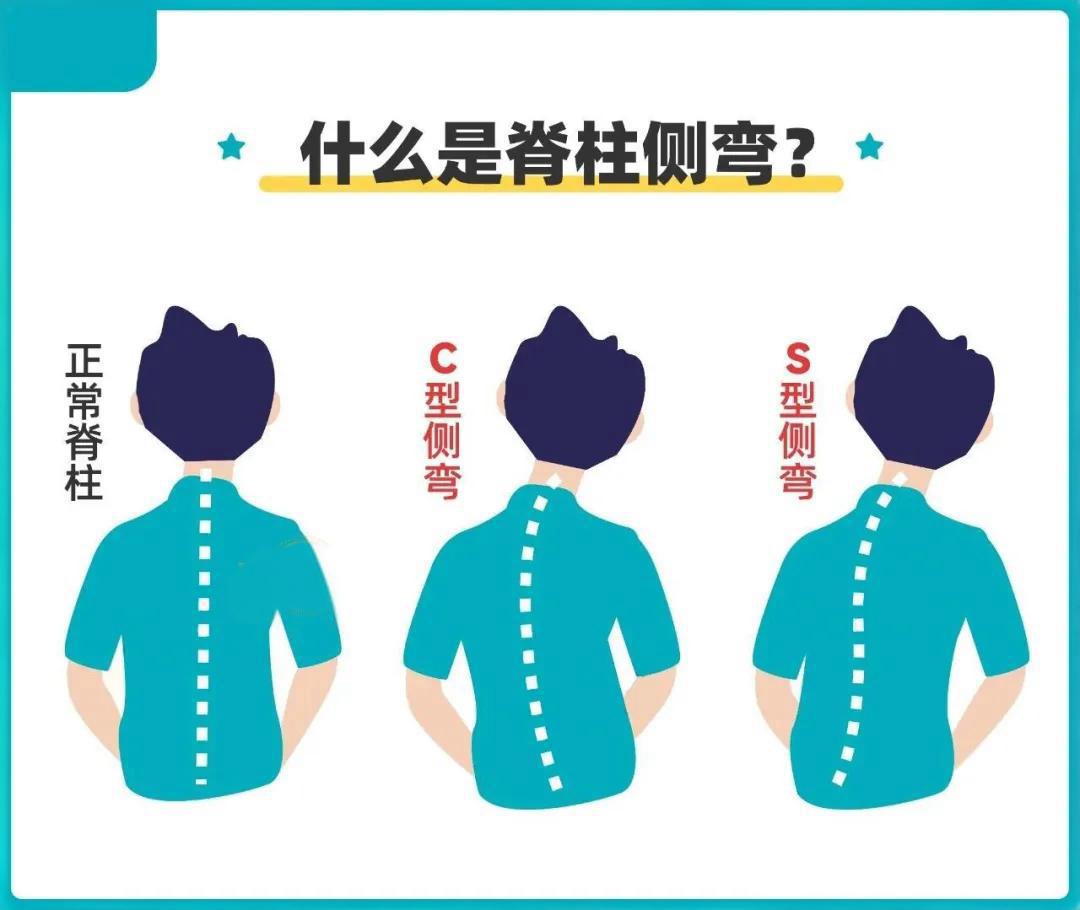脊柱侧弯与家庭自查