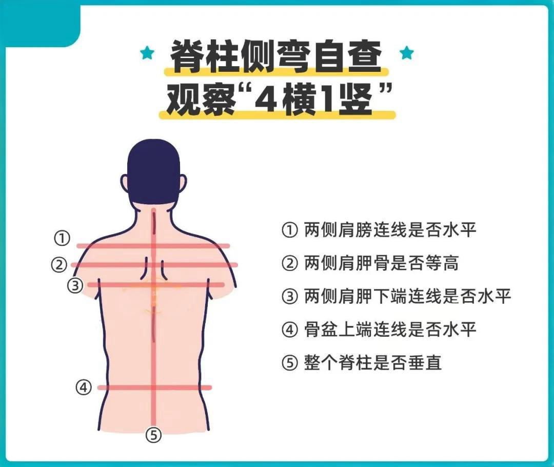 脊柱侧弯与家庭自查