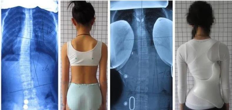 脊柱侧弯矫正的误区-——希望能矫正到0°