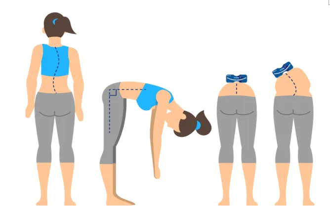 脊柱侧弯支具穿戴3个月要及时复查