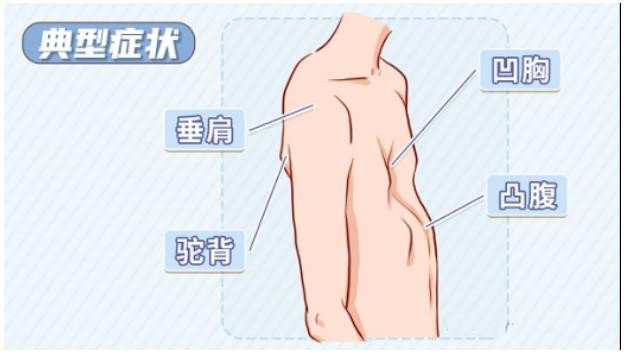 漏斗胸怎么矫正？