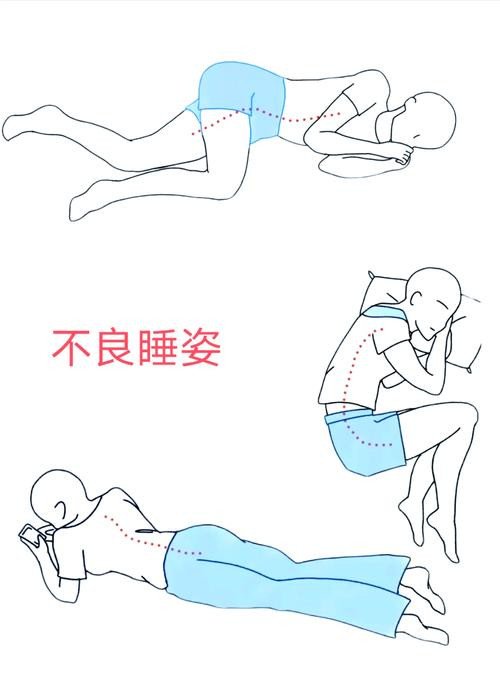睡姿对脊柱侧弯患者的影响