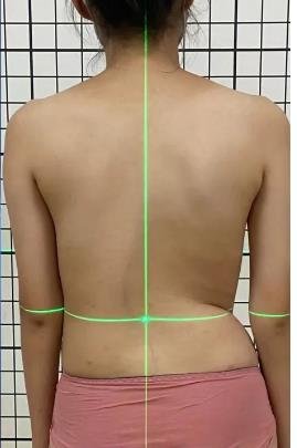 睡姿对脊柱侧弯患者的影响