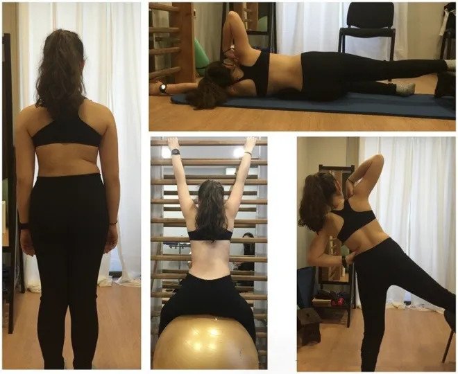 成人脊柱侧弯怎么办?