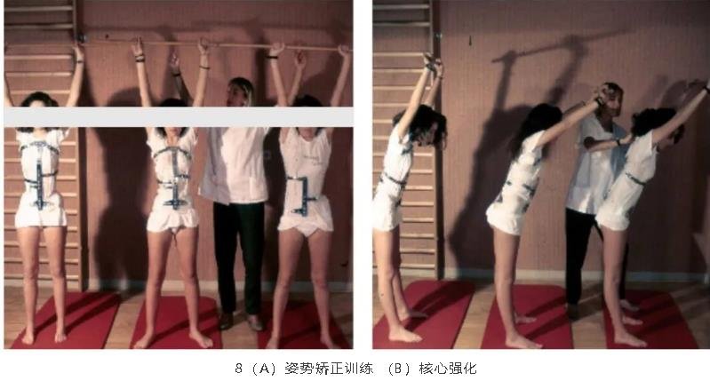法国里昂的一种脊柱侧弯康复办法