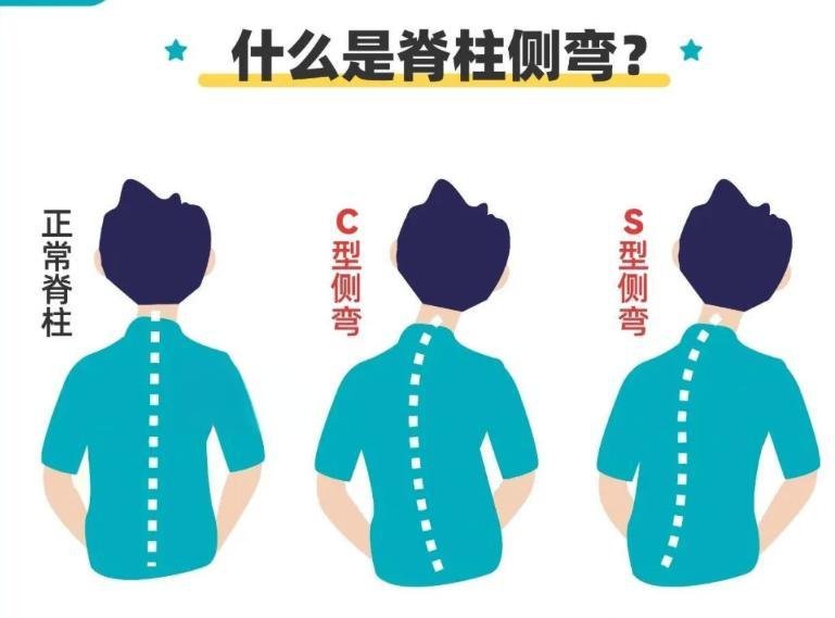 脊柱侧弯的确认与治疗