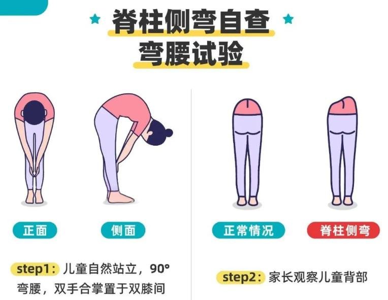 脊柱侧弯的确认与治疗