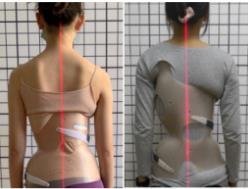 脊柱侧弯的确认与治疗