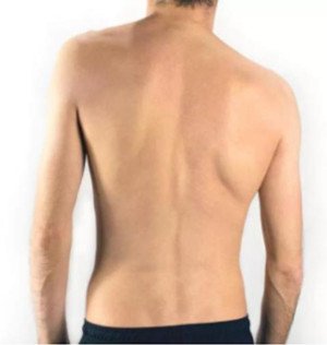 脊柱侧弯的确认与治疗