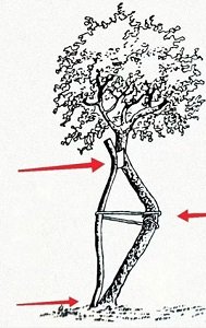 脊柱侧弯的确认与治疗