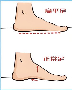 扁平足的危害